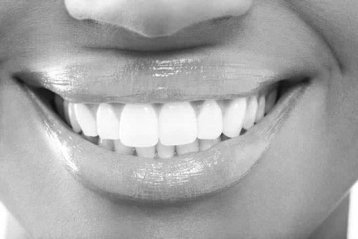 Advanced Invisalign® Techniques Used by Diamond Providers