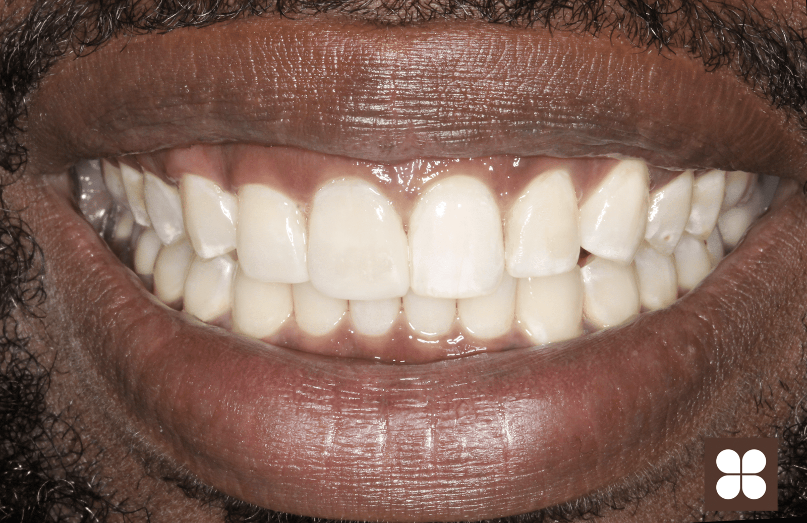 Julian after Invisalign