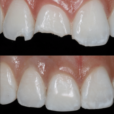 A before and after photo of the benefits of dental bonding