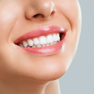 close-up of a woman's smile, representing teeth whitening options
