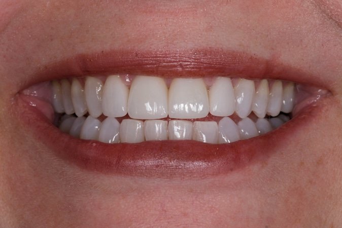 dental veneers at Fair Lakes Dentistry Fair Lakes Family and Cosmetic Dentistry