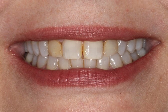 before veneers Fair Lakes Family and Cosmetic Dentistry