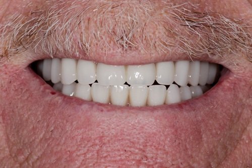 after cosmetic restoration Fair Lakes Family and Cosmetic Dentistry