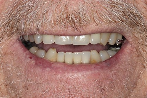 before restoration dentistry Fair Lakes Family and Cosmetic Dentistry