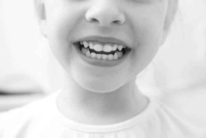 Fair Lakes Family Cosmetic Dentistry Childs Open Mouth Smile Fair Lakes Family Cosmetic Dentistry Childs Open Mouth Smile