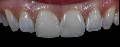 dental bonding Fair Lakes Family and Cosmetic Dentistry