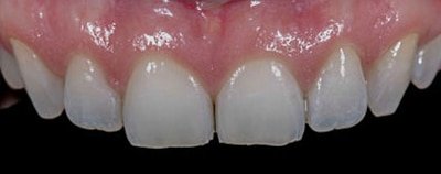 before dental bonding Fair Lakes Family and Cosmetic Dentistry