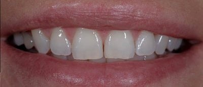 before bonding Fair Lakes Dentistry