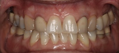 before cosmetic restoration Fair Lakes Family and Cosmetic Dentistry