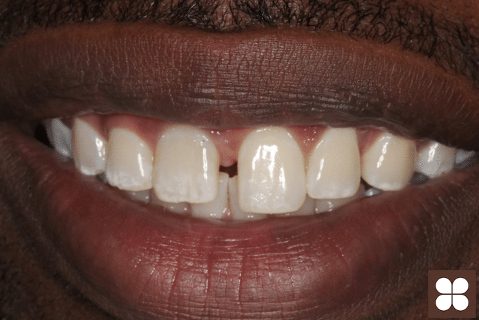 Before Invisalign Julian