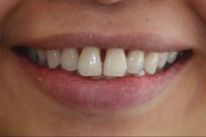 Veneers before photo smile