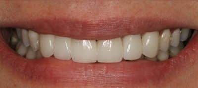 crown and bridge after smile