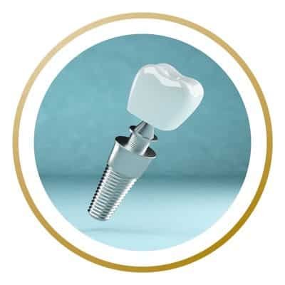 dental implant