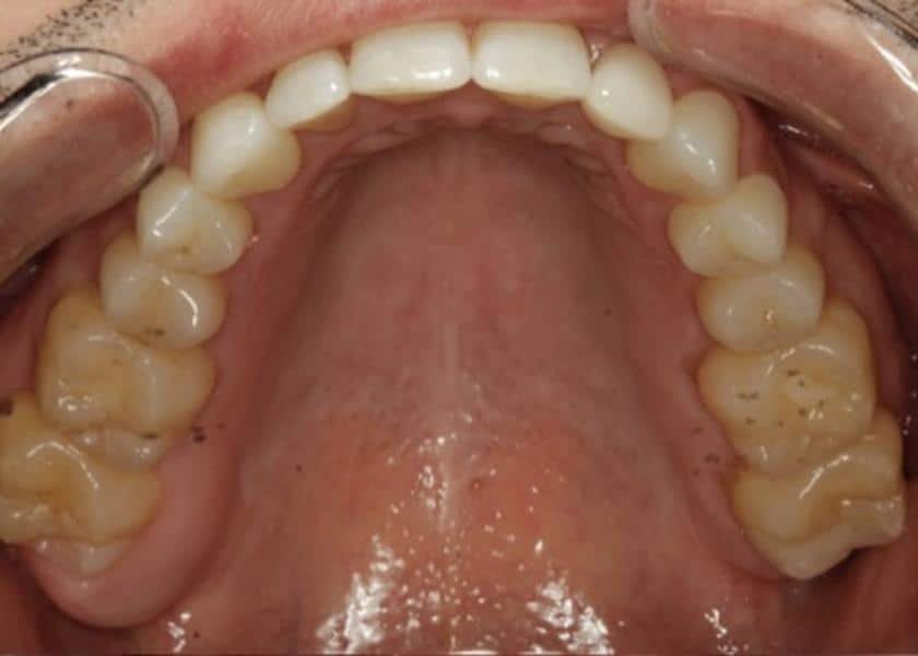 after treatment peg lateral results
