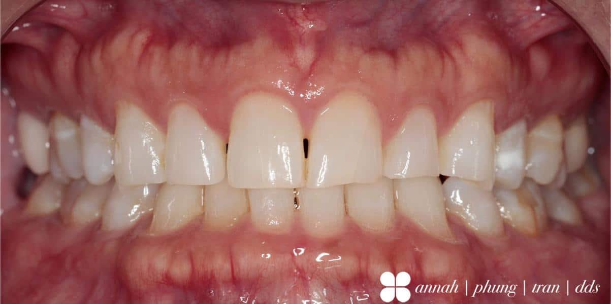 before treatment with veneers smile