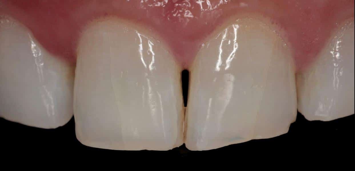 before treatment with veneers